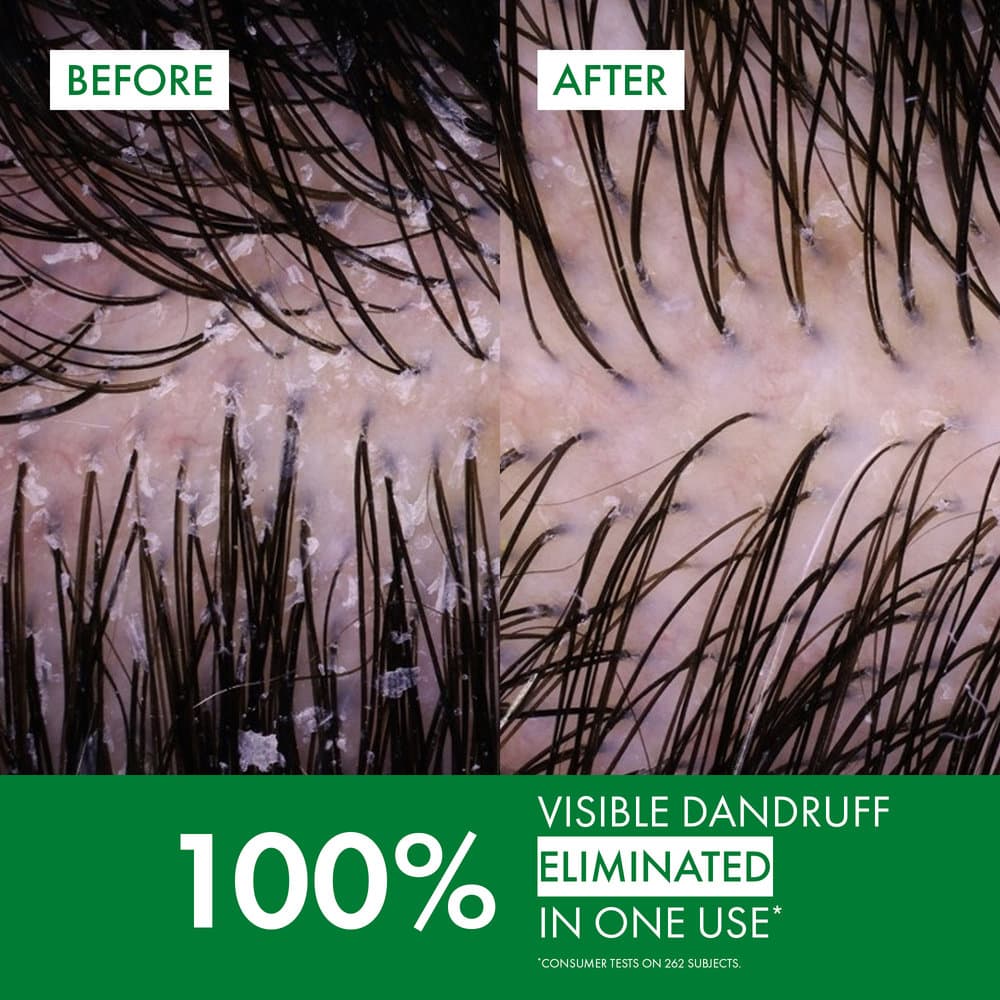 Vichy Dercos Anti-Dandruff Shampoo Normal to Oily Hair